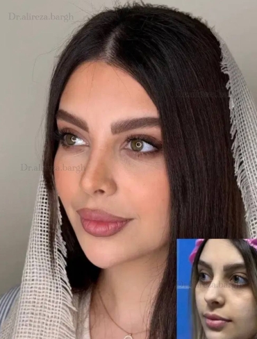 بینی استخوانی 