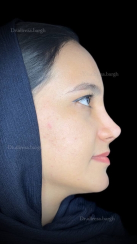 بینی استخوانی 