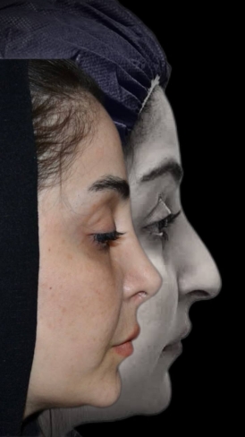 بینی استخوانی 