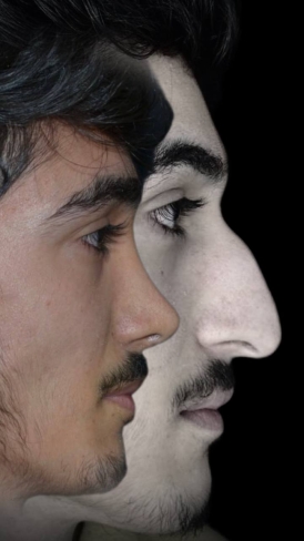 بینی استخوانی 