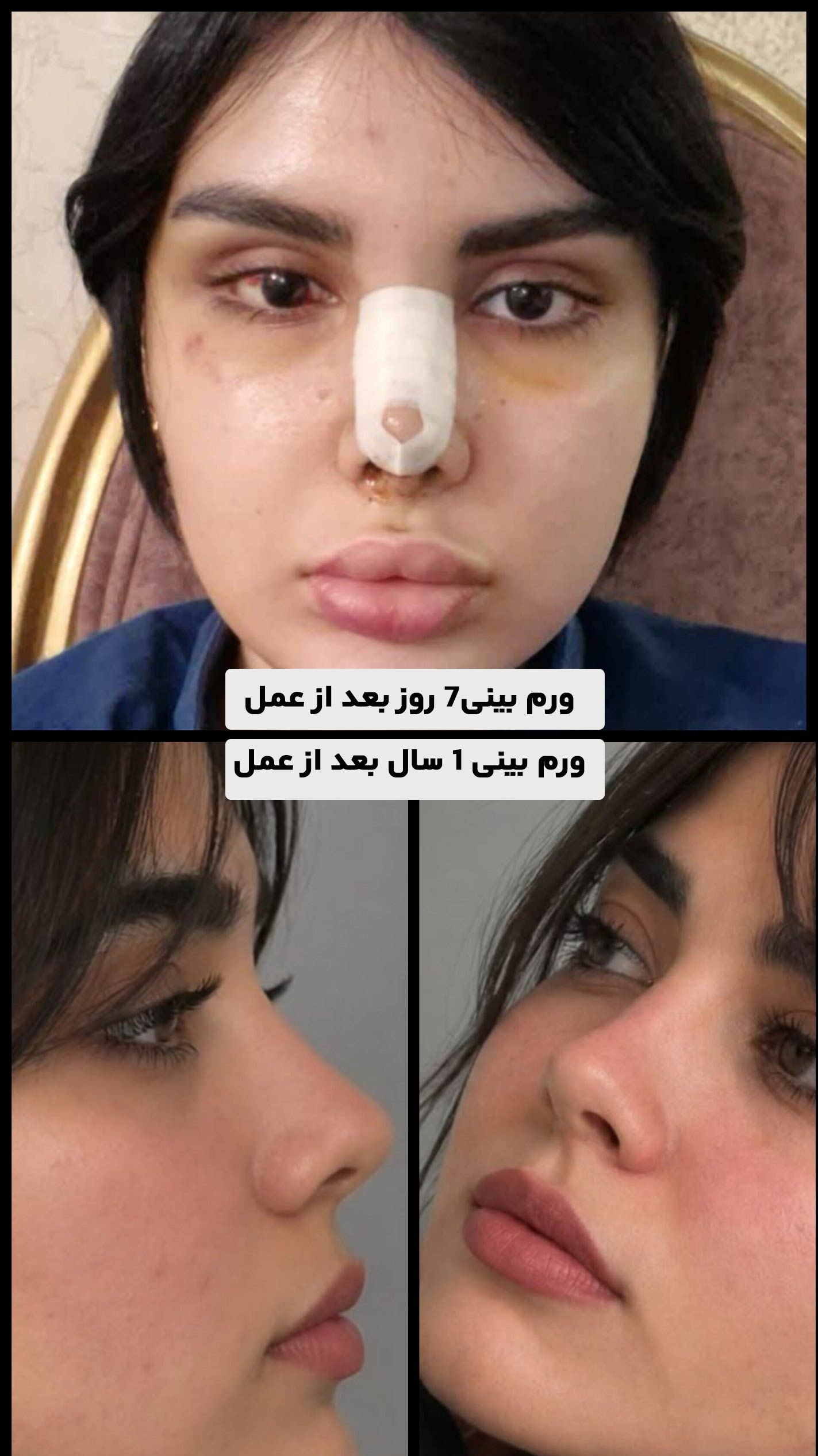 ورم بینی